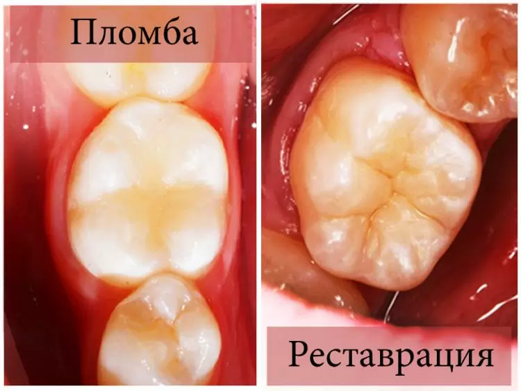 Dental filling and dental restoration - what is the difference?