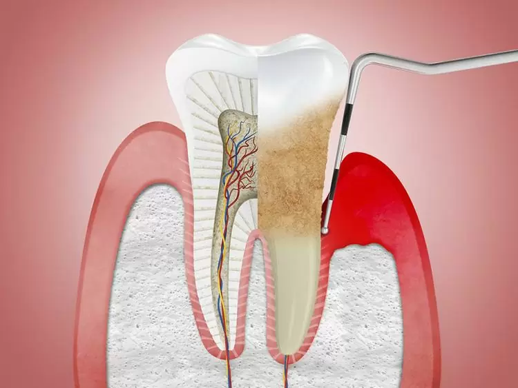 How is gingivitis treated? What is used to treat it?