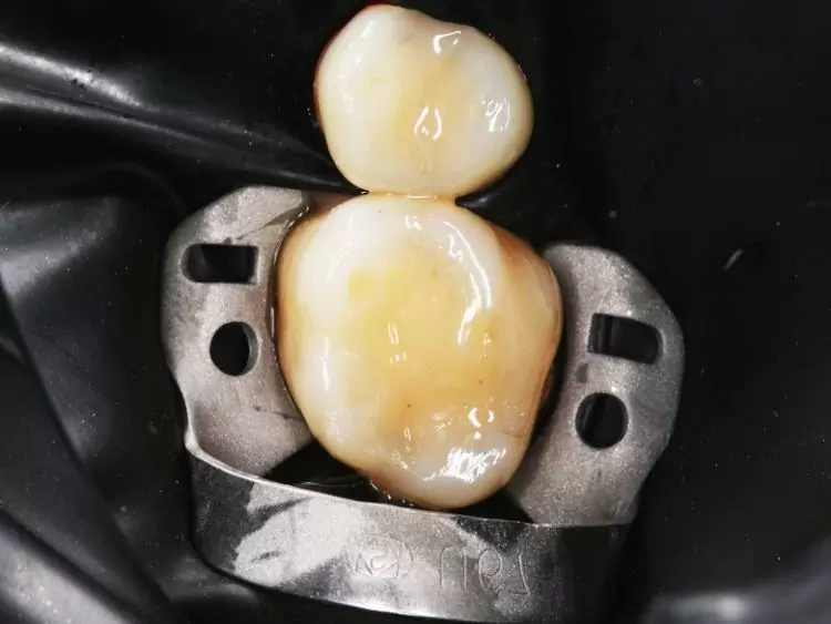 Dental filling and dental restoration - what is the difference?